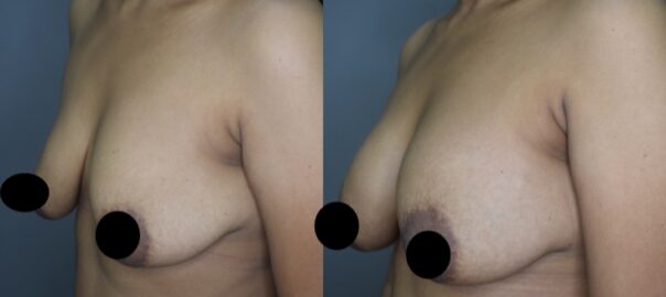 Breast Augmentation with Fat Fill