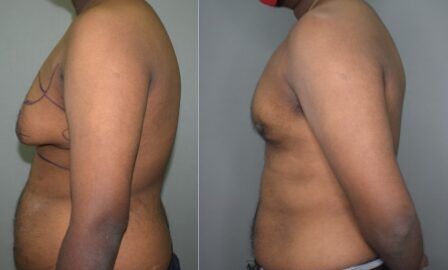 Gynecomastia Grade 3