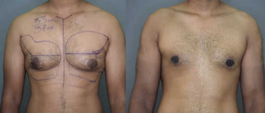 Gynecomastia Grade 2