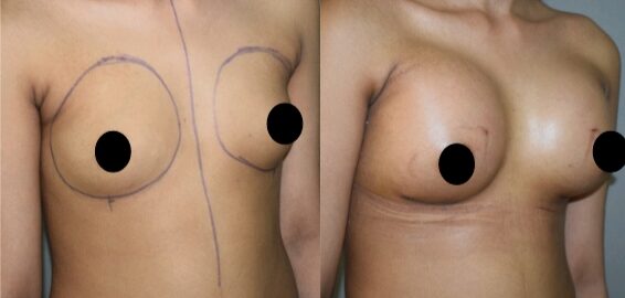 Breast Augmentation with Implant