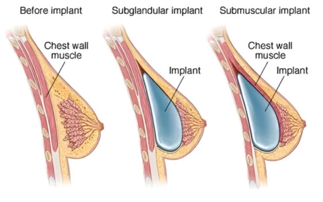 Breast Augmentation