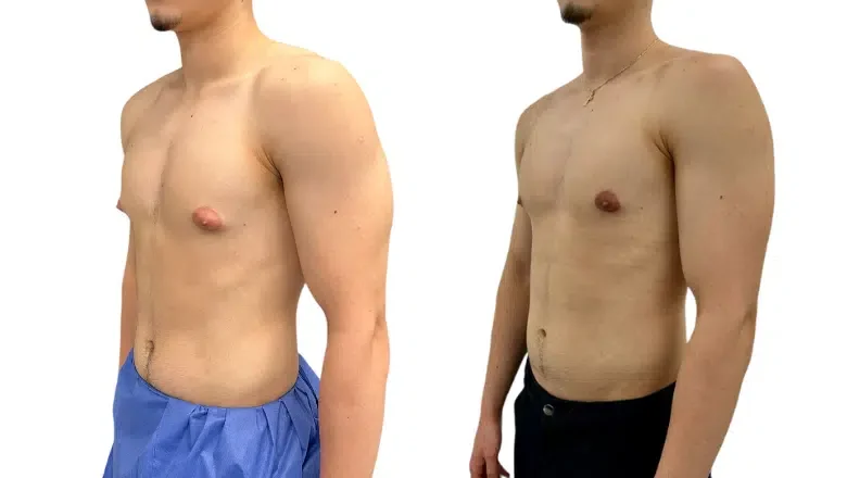 Gynecomastia vs Chest Fat