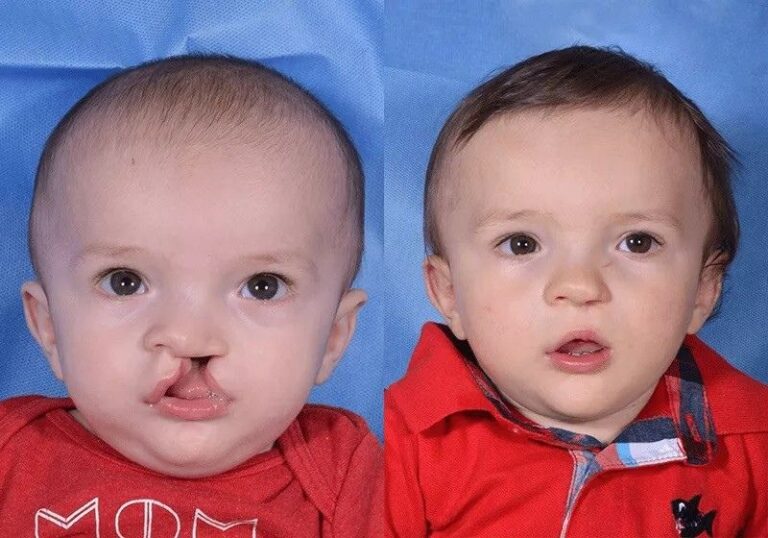 Cleft Lip Repair Surgery