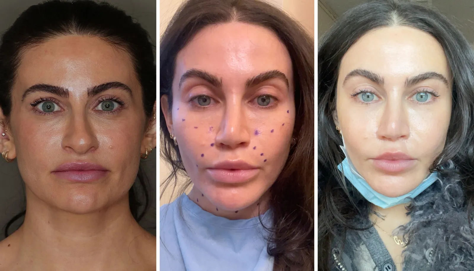 Tips for a Smooth Facial Fat Grafting Recovery