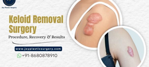 Keloid Removal Surgery