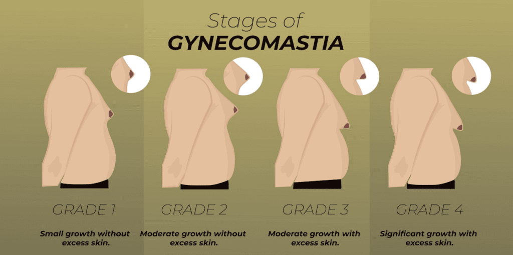 Gynecomastia vs Chest Fat