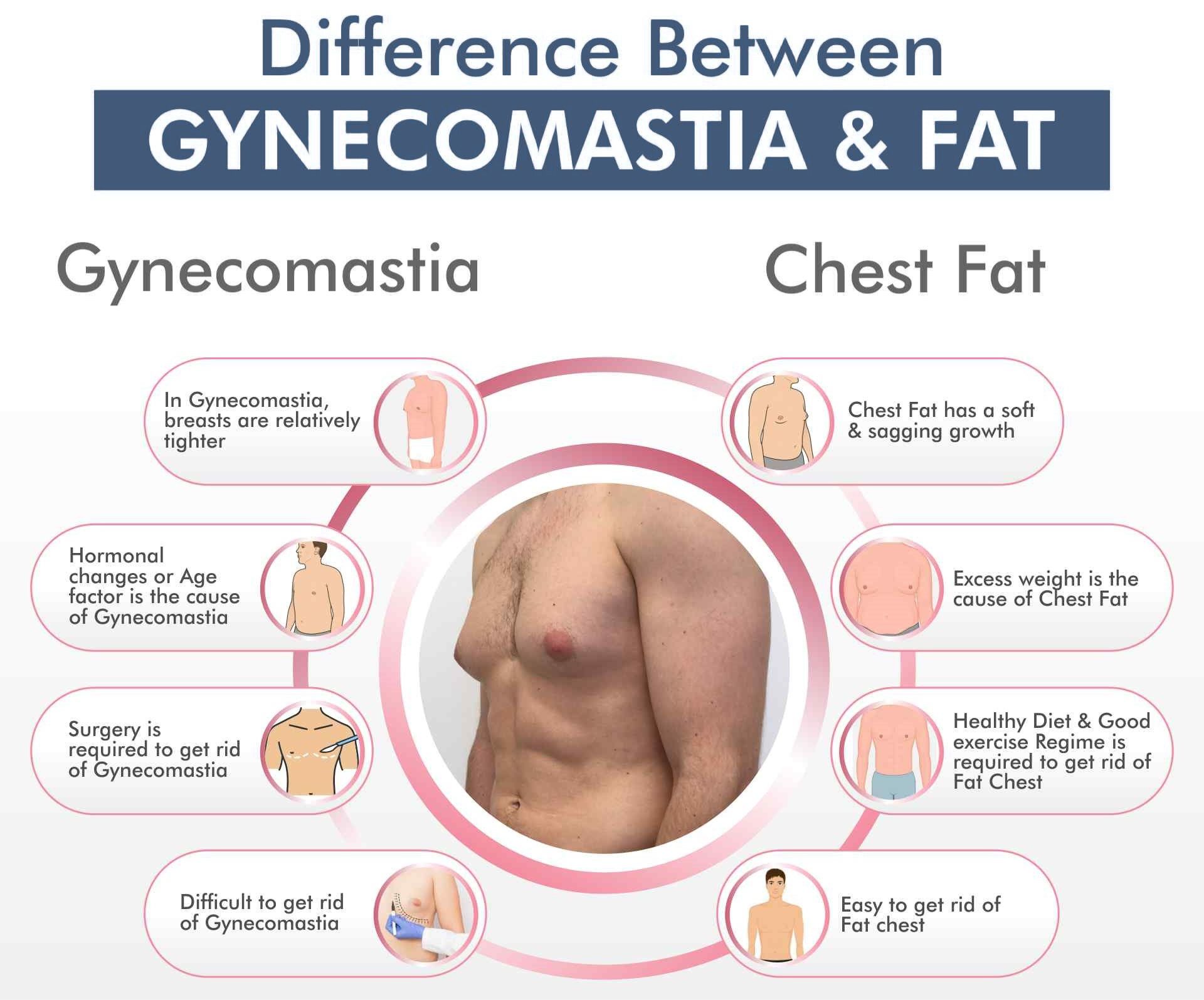 Gynecomastia vs Chest Fat